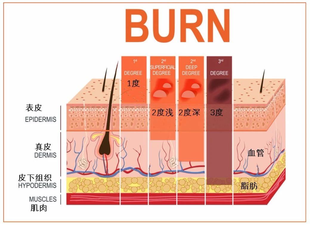 烫伤后怎么恢复最快，烧烫伤应该怎么处理，紧急方法是什么？